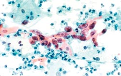 Human papillomavirus: increased testing for patients at risk of cervical cancer