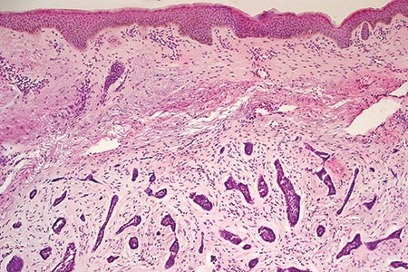 Mohs and the benefits of new embedding  and staining systems