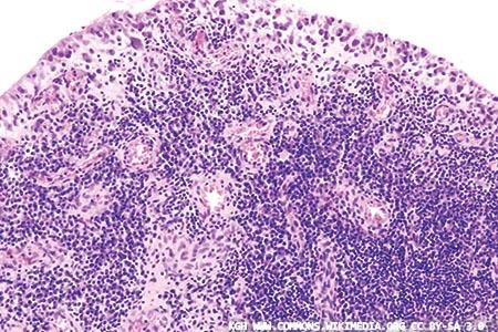T helper 17 cells: roles in the pathogenesis of rheumatoid arthritis