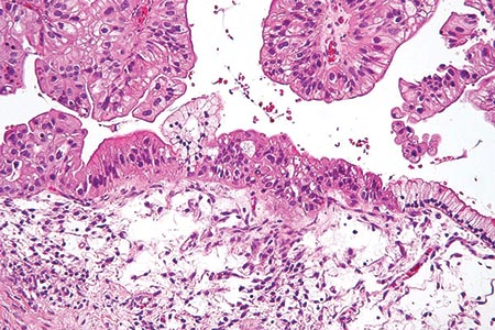 Ovarian cancer: update on serum biomarkers