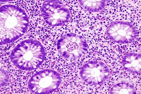New therapeutic options for inflammatory bowel conditions