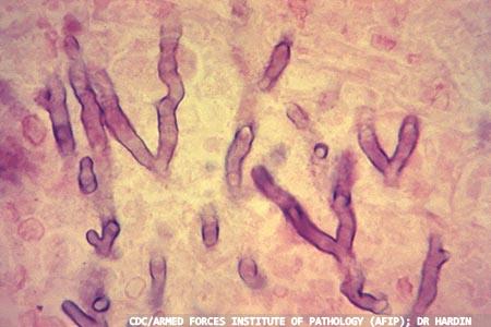 Pre Emptively Treating Invasive Aspergillosis Rapid Diagnosis By Pcr