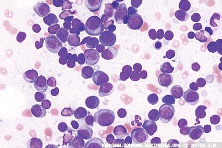 Multiple myeloma and molecular pathology: a selection of articles  in the current literature