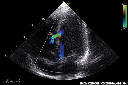 Cardiac troponins and the diagnosis of heart disease: some articles in the current literature