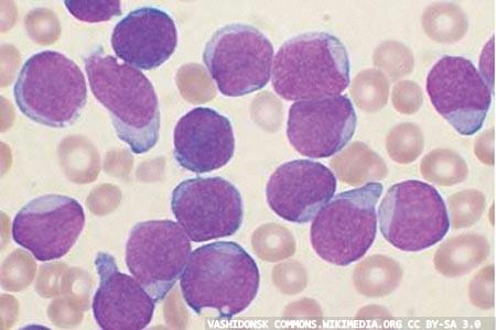 Lymphoid leukaemia:  a look at the genetics  of proliferation