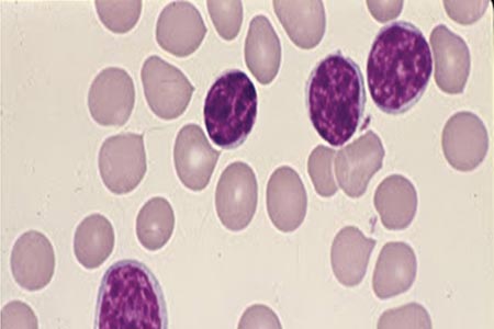 Leukaemia and lymphoma:  an example of how flow  cytometry aids diagnosis 