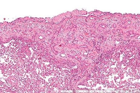 Mutation of the BAP1 gene in malignant mesothelioma: a diagnostic evaluation