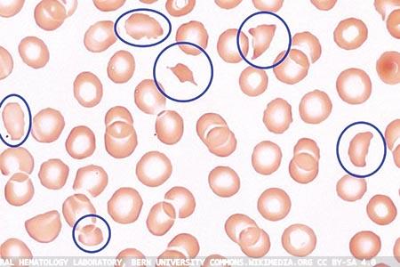 Blood coagulation: what’s new from the UK NEQAS BC scheme?