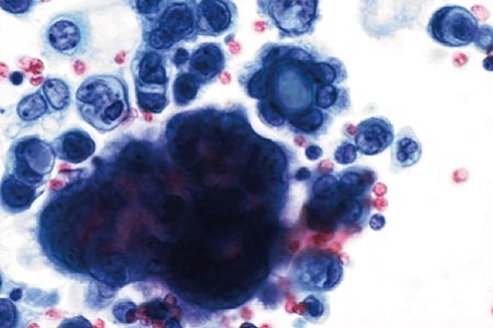 Non-gynaecological cytopathology: the importance of preparation