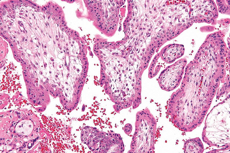 Fetal red cell and platelet antigen genotyping: progress and pitfalls