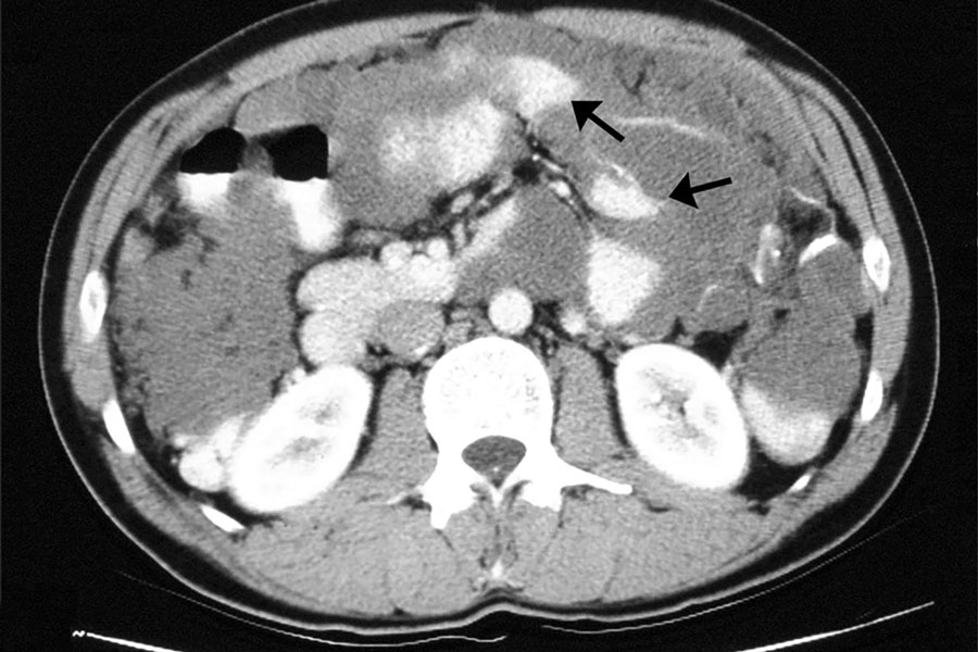 Automated thrombin  generation offers insights  into peritoneal cancer