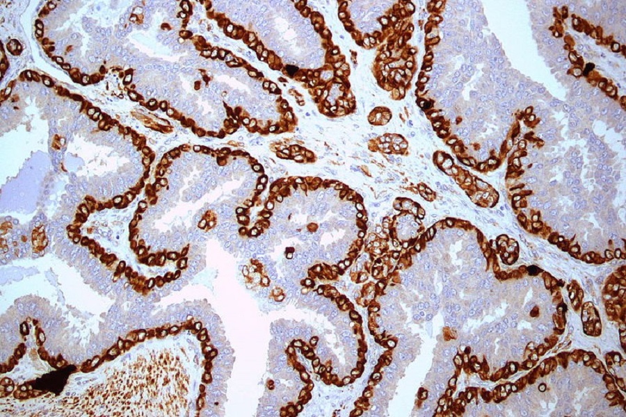 Improving cancer diagnosis with digital pathology image analysis