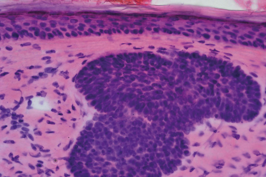 Microscopy of cutaneous malignancies:  an H&E subtype evaluation