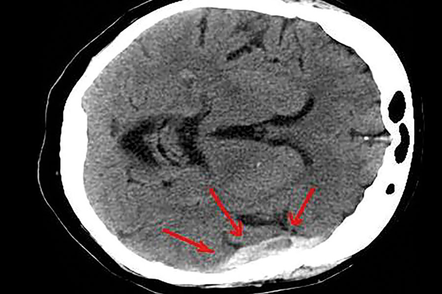 Traumatic brain injury test: clinical performance summary of a pivotal study