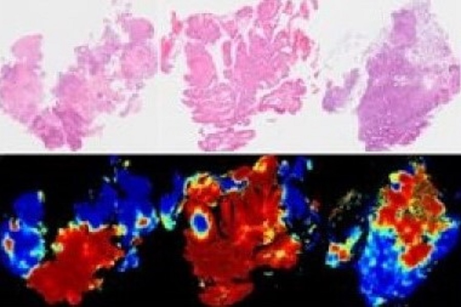 AI-based pathology diagnosis tool in development detects seven types of gastric cancer