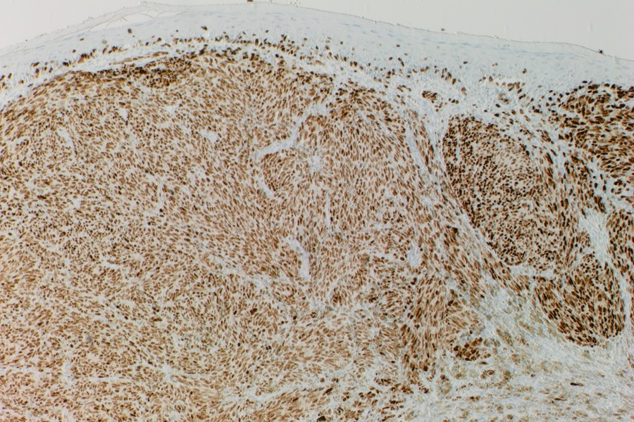 Roche adds to dermatology biomarkers with new PRAME antibody