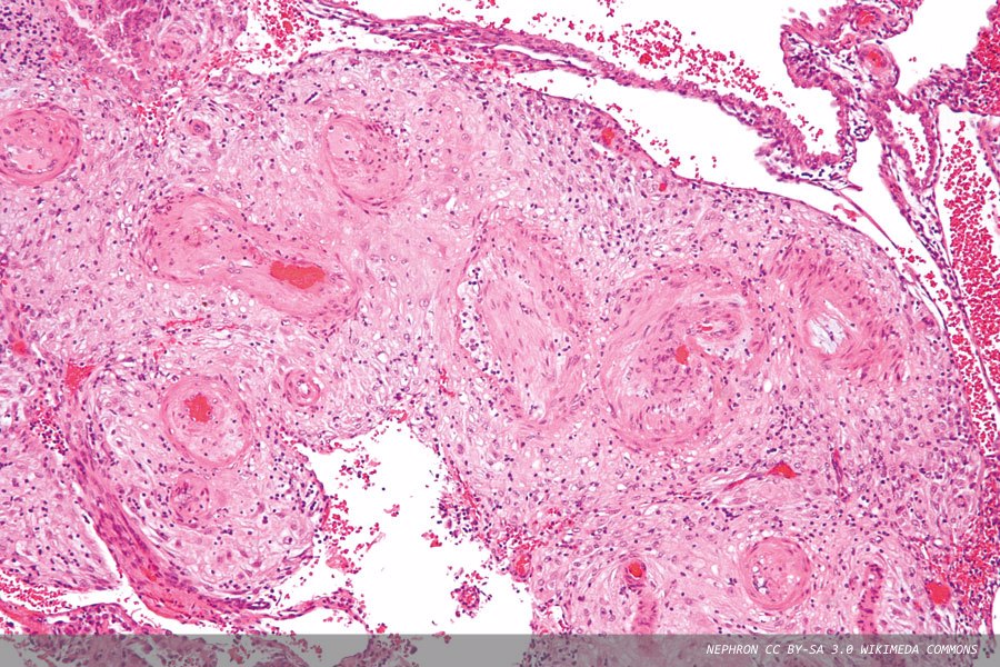 Predicting risk of pre-eclampsia with PIGF-based testing