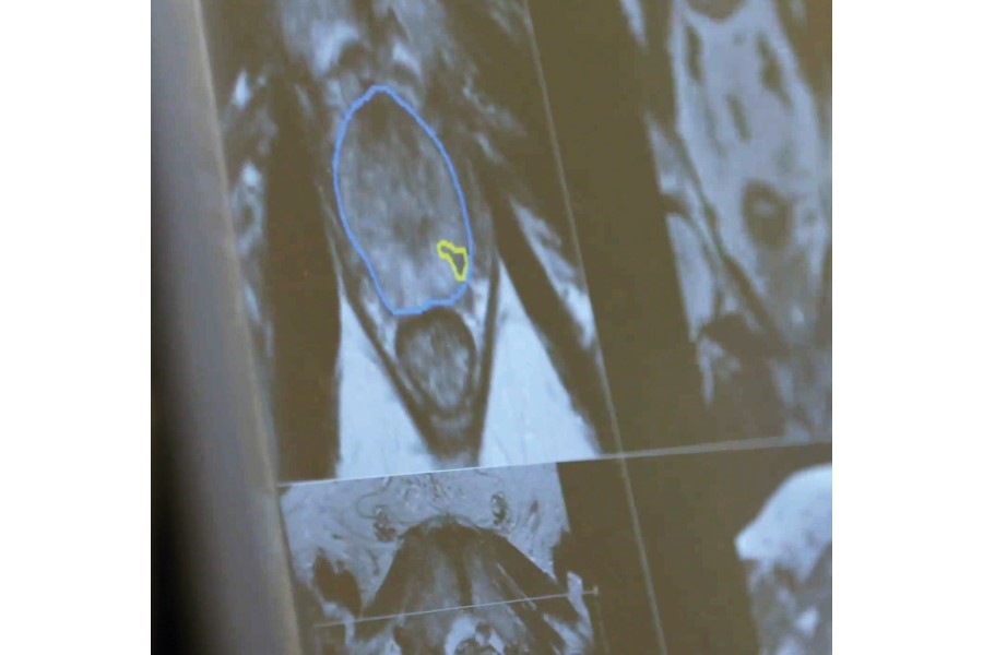 Groves Medical Group starts offering Stockholm3 in the UK
