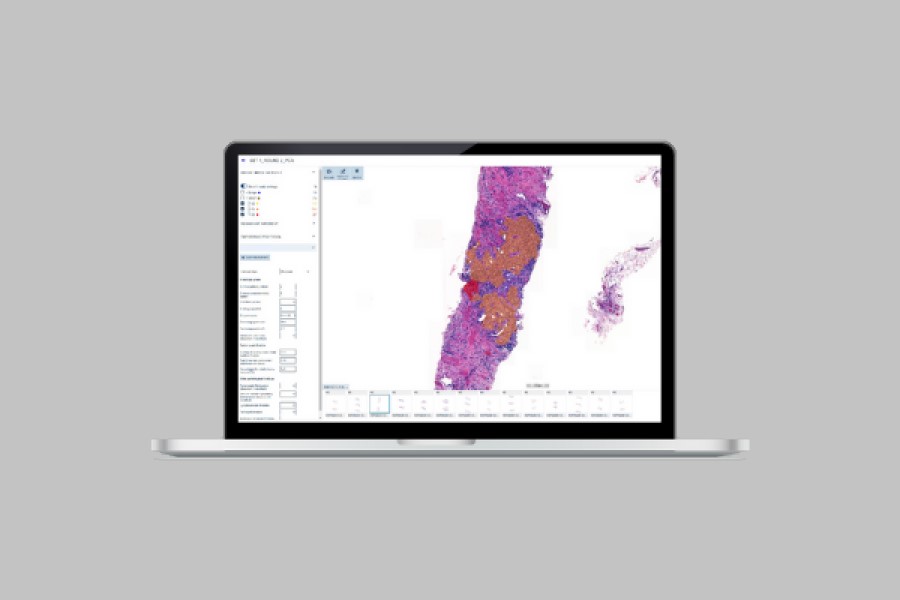 First NHS Trust to adopt Aiforia’s lung cancer model in clinical diagnostics