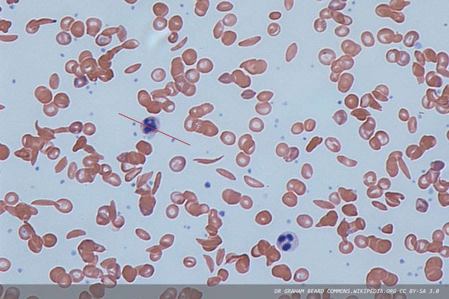 Gene-editing therapy gains FDA approval for sickle cell treatment