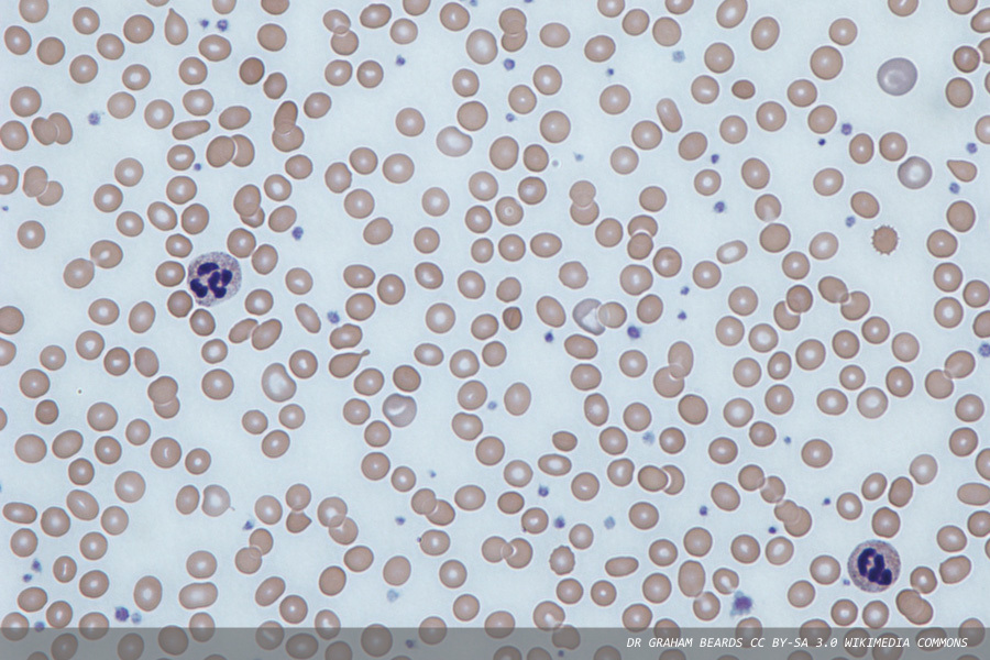 Reticulocyte haemoglobin content: a pilot UK NEQAS Haematology assessment