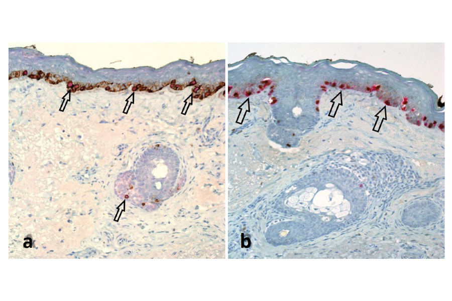 Lentigo maligna: value of PRAME/Melan A IHC double-labelling