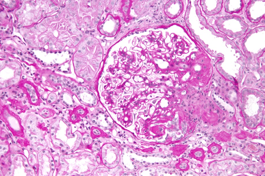 New technique detects novel biomarkers for kidney diseases with nephrotic syndrome