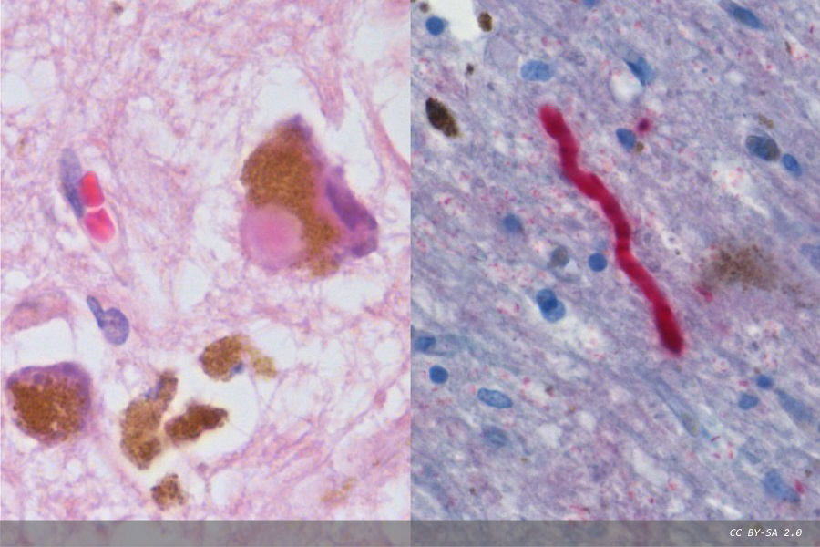 Test for alpha-synuclein protein could revolutionise Parkinson's disease diagnostics