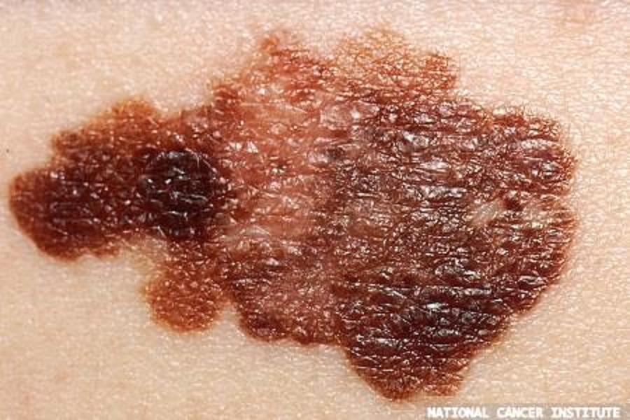 Melanoma diagnostic receives UKCA mark