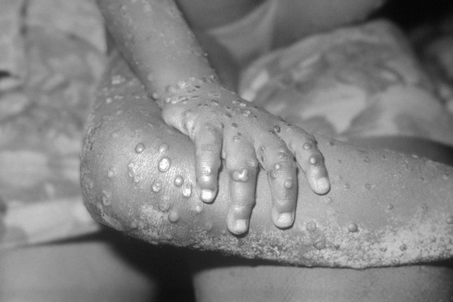 UKHSA detects further cases of Clade Ib mpox 