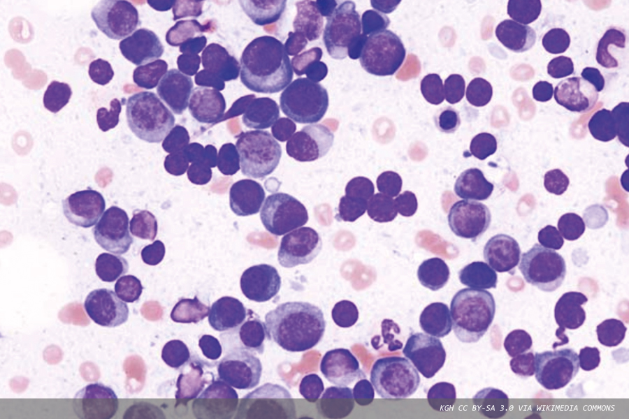 Overcoming the barriers preventing early diagnosis of multiple myeloma
