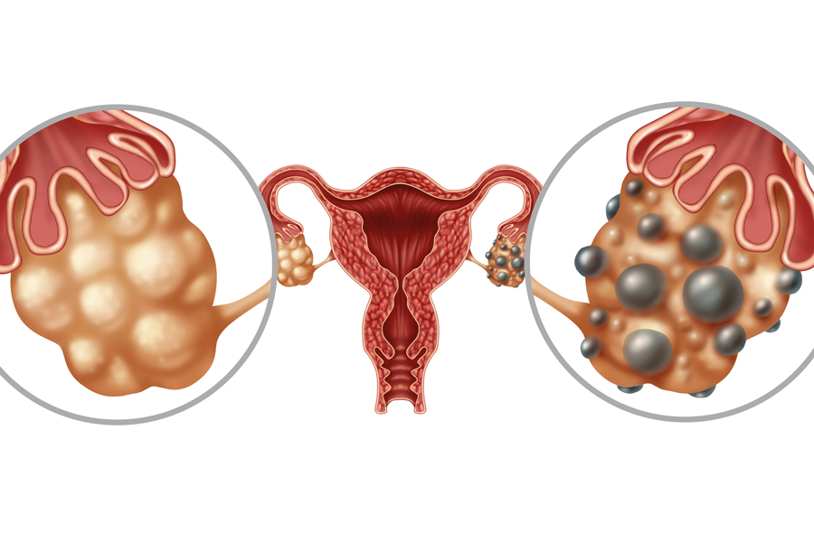 Polycystic ovary syndrome testing: a need for better guidance