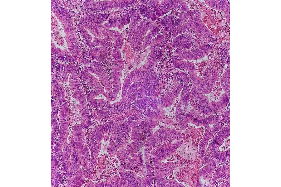 Gut bacteria can reveal colorectal cancer